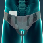 Tynor Inguinal Support Belt A-16 with Dual Removable Compression Pads - Image 3